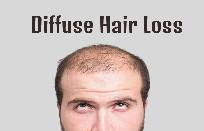 Diffuse Hair Loss